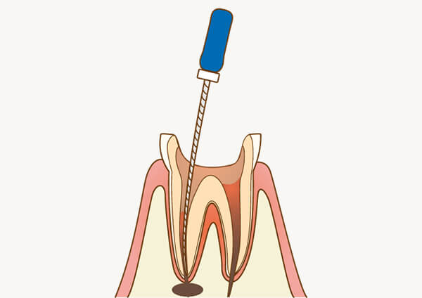 根管治療とは