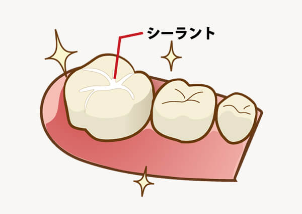 シーラント処置