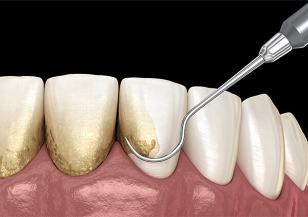 プラーク、歯石の除去